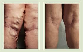 Флебэктомия (венэктомия): виды и ход операции, послеоперационный период, показания