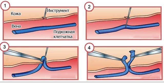 Флебэктомия (венэктомия): виды и ход операции, послеоперационный период, показания