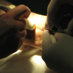 Флебэктомия (венэктомия): виды и ход операции, послеоперационный период, показания