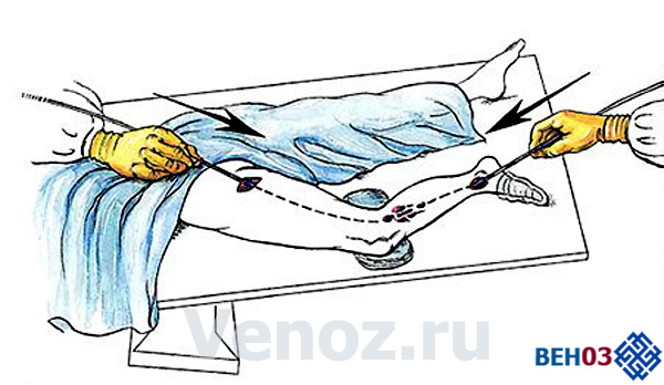 Флебэктомия (венэктомия): виды и ход операции, послеоперационный период, показания