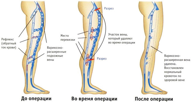 Флебэктомия (венэктомия): виды и ход операции, послеоперационный период, показания