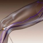 Флебэктомия (венэктомия): виды и ход операции, послеоперационный период, показания