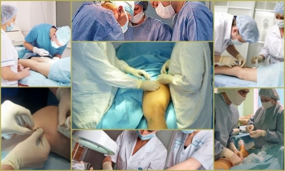 Флебэктомия (венэктомия): виды и ход операции, послеоперационный период, показания