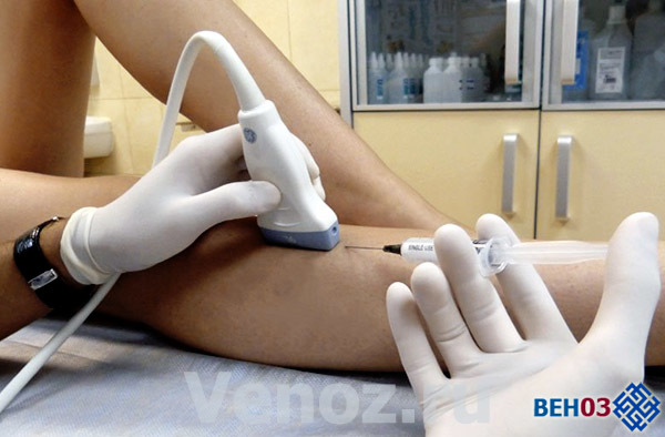 Флебэктомия (венэктомия): виды и ход операции, послеоперационный период, показания