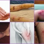 Флебэктомия (венэктомия): виды и ход операции, послеоперационный период, показания