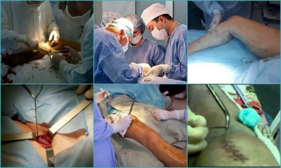 Флебэктомия (венэктомия): виды и ход операции, послеоперационный период, показания