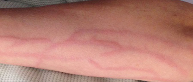 Флебит (воспаление) вены на руке: лечение