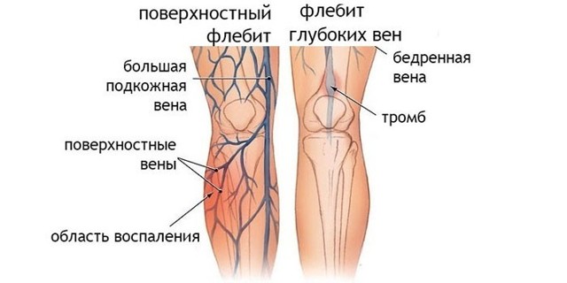 Флебит (воспаление) вены на руке: лечение