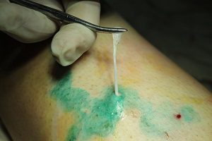 Флебит (воспаление) вены на руке: лечение