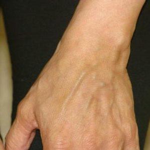 Флебит (воспаление) вены на руке: лечение