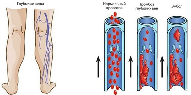 Флебит (воспаление) вены на руке: лечение
