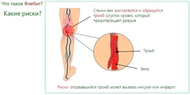 Флебит (воспаление) вены на руке: лечение