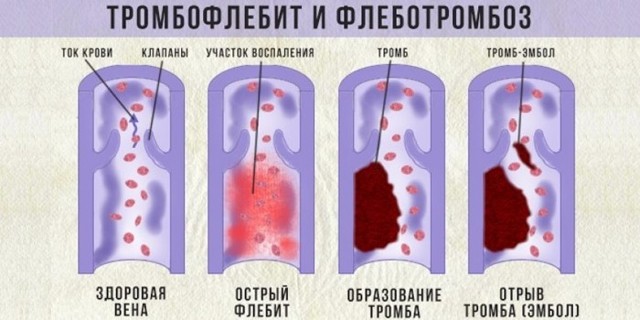 Флебит (воспаление) вены на руке: лечение