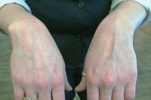 Флебит (воспаление) вены на руке: лечение