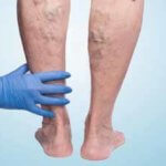 Флебит (воспаление) вены на руке: лечение