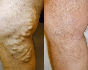 Флеботоники: что это за препараты, когда назначают, список, отзывы