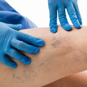 Флеботоники: что это за препараты, когда назначают, список, отзывы