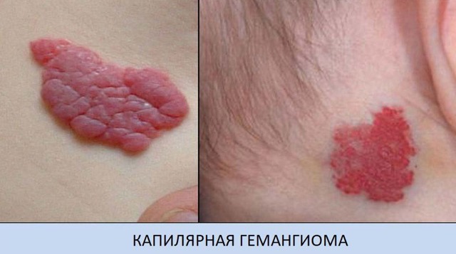 Гемангиома на голове у новорожденного ребенка: причины, диагностика, лечение, осложнения