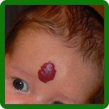 Гемангиома на голове у новорожденного ребенка: причины, диагностика, лечение, осложнения