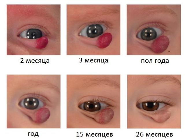 Гемангиома на голове у новорожденного ребенка: причины, диагностика, лечение, осложнения