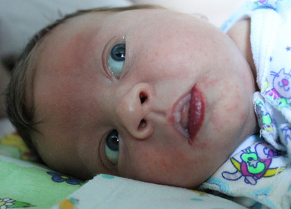 Гемангиома на голове у новорожденного ребенка: причины, диагностика, лечение, осложнения