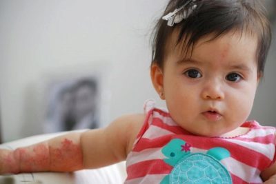 Гемангиома на голове у новорожденного ребенка: причины, диагностика, лечение, осложнения