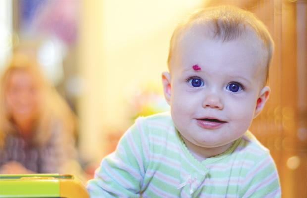 Гемангиома на голове у новорожденного ребенка: причины, диагностика, лечение, осложнения