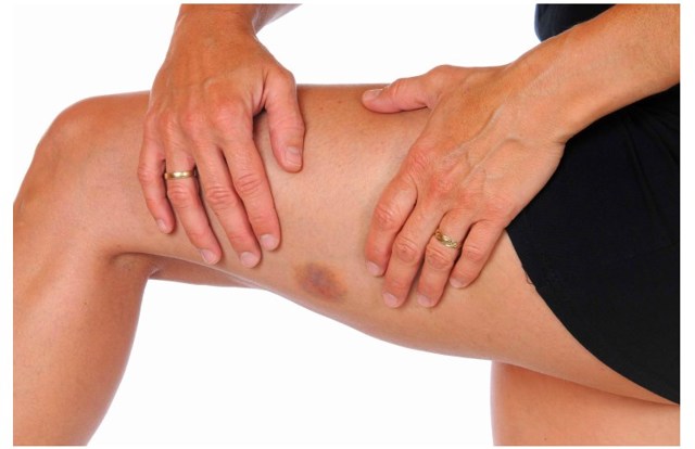 Гепариновая мазь при варикозе – инструкция по применению, отзывы, аналоги, форма выпуска, побочные действия, противопоказания, цена