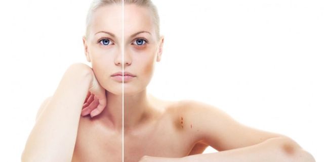 Гепариновая мазь при варикозе – инструкция по применению, отзывы, аналоги, форма выпуска, побочные действия, противопоказания, цена