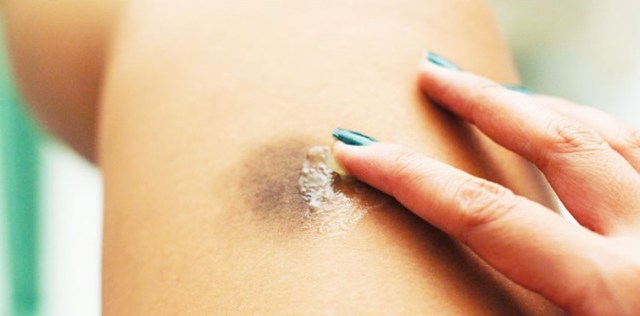 Гепариновая мазь при варикозе – инструкция по применению, отзывы, аналоги, форма выпуска, побочные действия, противопоказания, цена