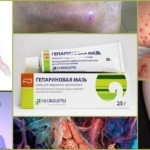 Гепатромбин г и гепариновая мазь: что лучше и в чем разница (отличие составов, отзывы врачей)