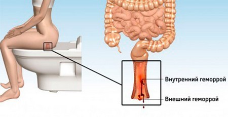 Гепатромбин г и гепариновая мазь: что лучше и в чем разница (отличие составов, отзывы врачей)