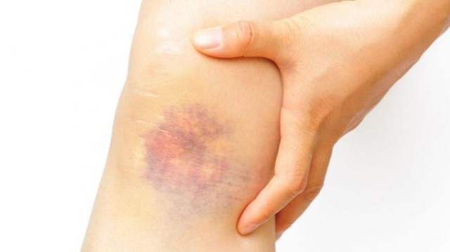 Гепатромбин и троксевазин: что лучше и в чем разница (отличие составов, отзывы врачей)