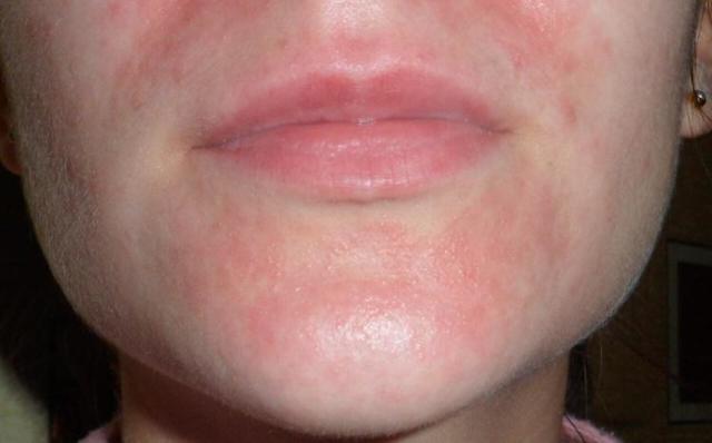 Гепатромбин и троксевазин: что лучше и в чем разница (отличие составов, отзывы врачей)