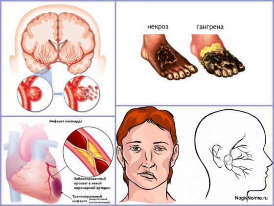 Гирудотерапия при варикозе: отзывы, польза и вред лечение варикоза пиявками, фото до и после