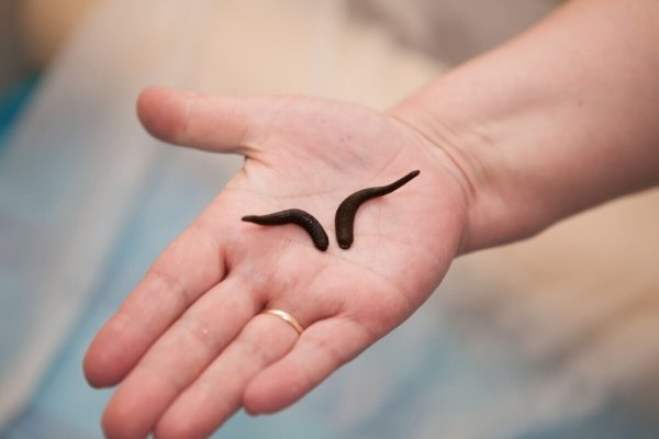 Гирудотерапия при варикозе: отзывы, польза и вред лечение варикоза пиявками, фото до и после