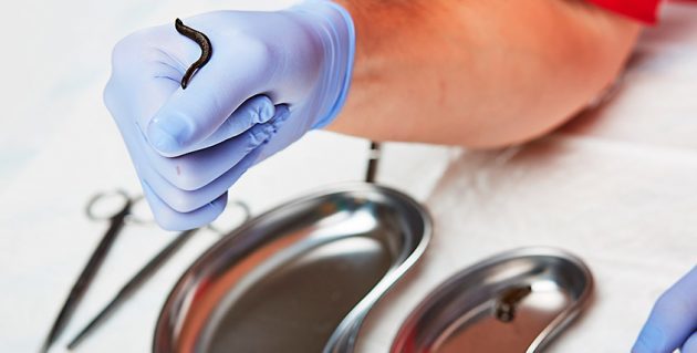 Гирудотерапия при варикозе: отзывы, польза и вред лечение варикоза пиявками, фото до и после