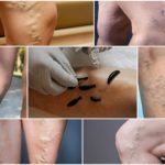 Гирудотерапия при варикозе: отзывы, польза и вред лечение варикоза пиявками, фото до и после