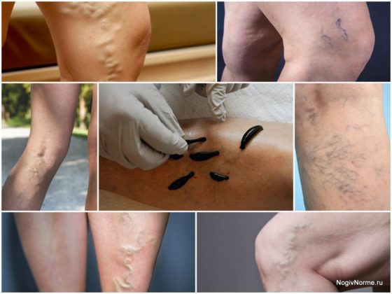 Гирудотерапия при варикозе: отзывы, польза и вред лечение варикоза пиявками, фото до и после