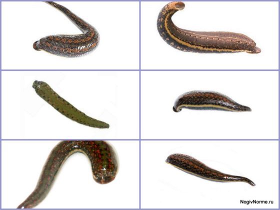 Гирудотерапия при варикозе: отзывы, польза и вред лечение варикоза пиявками, фото до и после