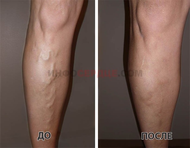 Гирудотерапия при варикозе: отзывы, польза и вред лечение варикоза пиявками, фото до и после