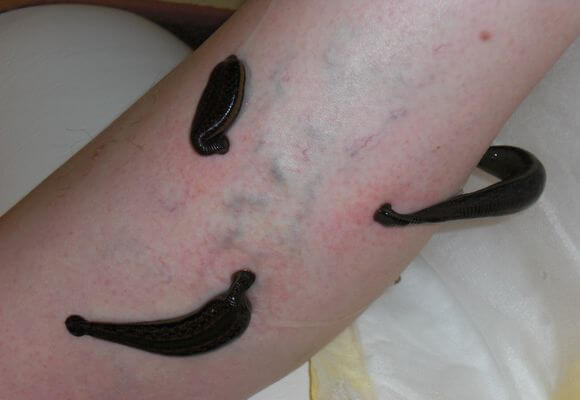 Гирудотерапия при варикозе: отзывы, польза и вред лечение варикоза пиявками, фото до и после