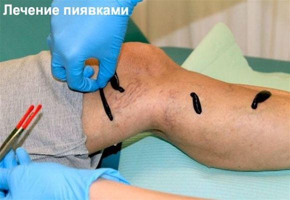 Гирудотерапия при варикозе: отзывы, польза и вред лечение варикоза пиявками, фото до и после
