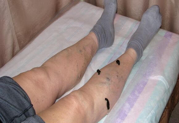 Гирудотерапия при варикозе: отзывы, польза и вред лечение варикоза пиявками, фото до и после