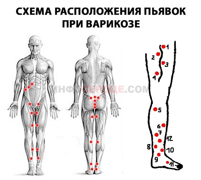Гирудотерапия при варикозе: отзывы, польза и вред лечение варикоза пиявками, фото до и после
