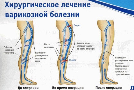 Хроническая венозная недостаточность (хвн) 1,2,3 степени: причины, симптомы, классификация сеар, лечение, профилактика, последствия