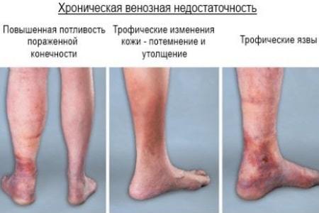 Хроническая венозная недостаточность (хвн) 1,2,3 степени: причины, симптомы, классификация сеар, лечение, профилактика, последствия