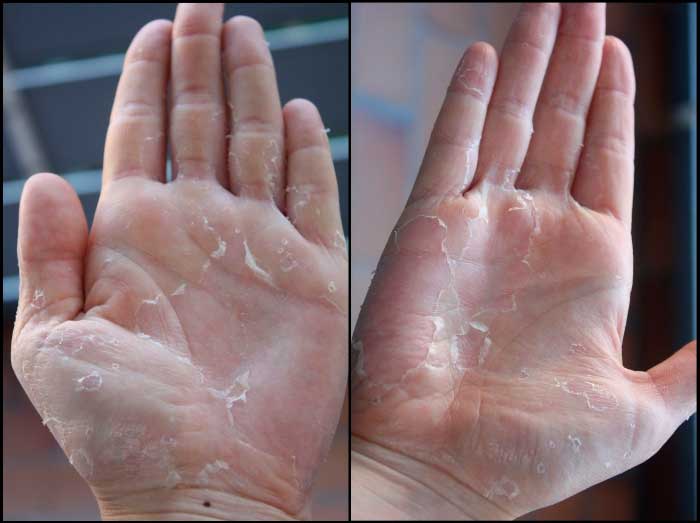 Избыток витамина д у грудничка симптомы