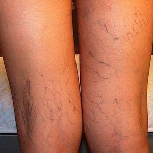 Яблочный уксус при варикозе на ногах: как пользоваться, отзывы, рецепты