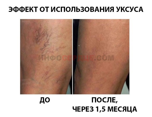 Яблочный уксус при варикозе на ногах: как пользоваться, отзывы, рецепты